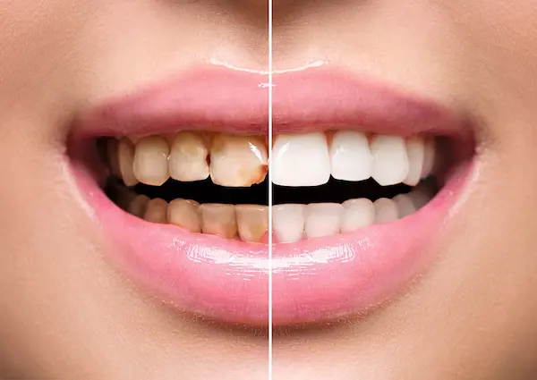 Cuidados después del blanqueamiento dental para una sonrisa perfecta