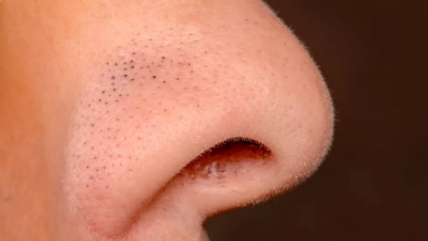 Errores comunes al tratar los puntos negros en la cara