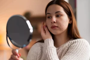 Puntos negros en la cara causas y rutina para reducirlos